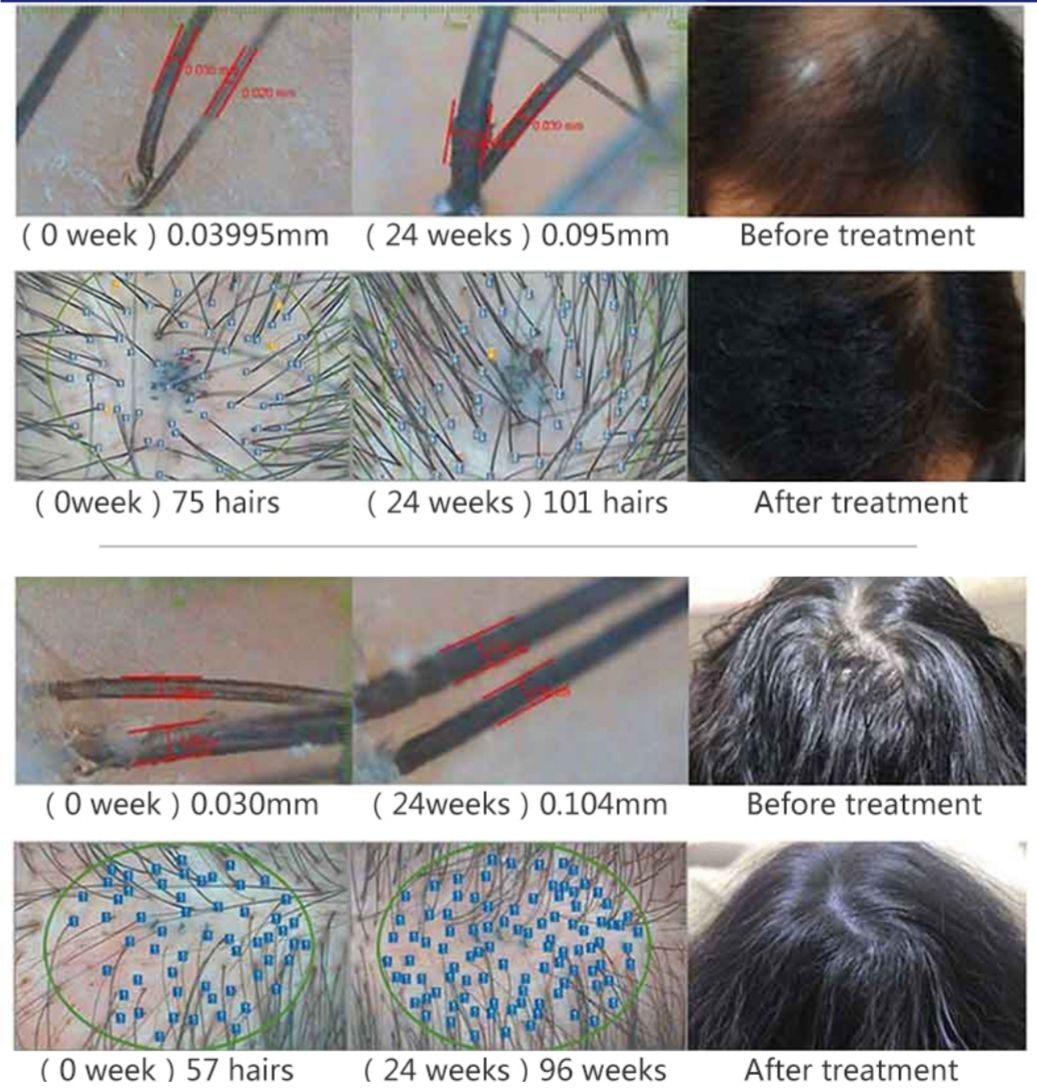 LLLT cheveux traitement calvitie alopécie