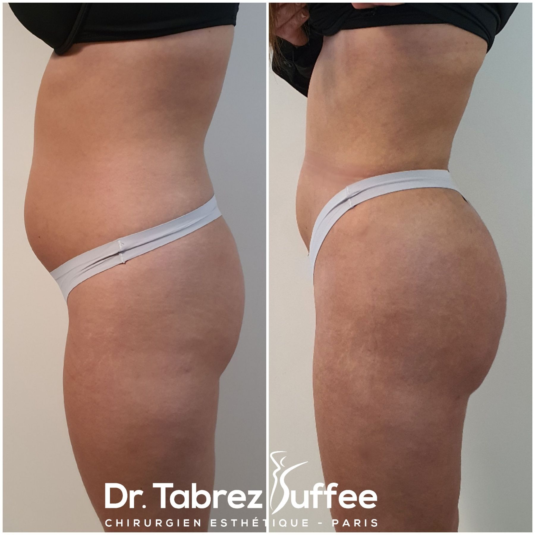 Brazilian Butt Lift, Lipofilling fesses sans anesthésie générale